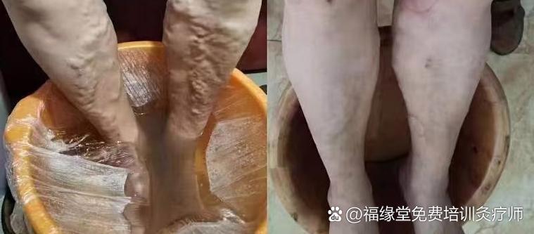 灸法调理三步走 从泡脚到膀胱经的完整养生指南